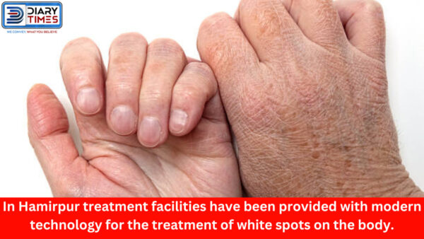 In Hamirpur treatment facilities have been provided with modern technology for the treatment of white spots on the body.