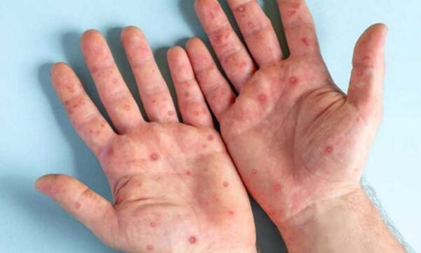 Himachal health department issues advisory on monkeypox amid global concerns