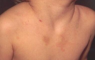 Rohru Teacher Suspended for Beating Student with Thorny Branch