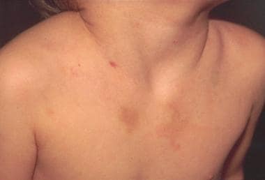 Rohru Teacher Suspended for Beating Student with Thorny Branch